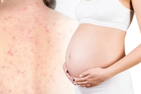 "Syphilis" a contagious disease, dangerous! with pregnant mothers